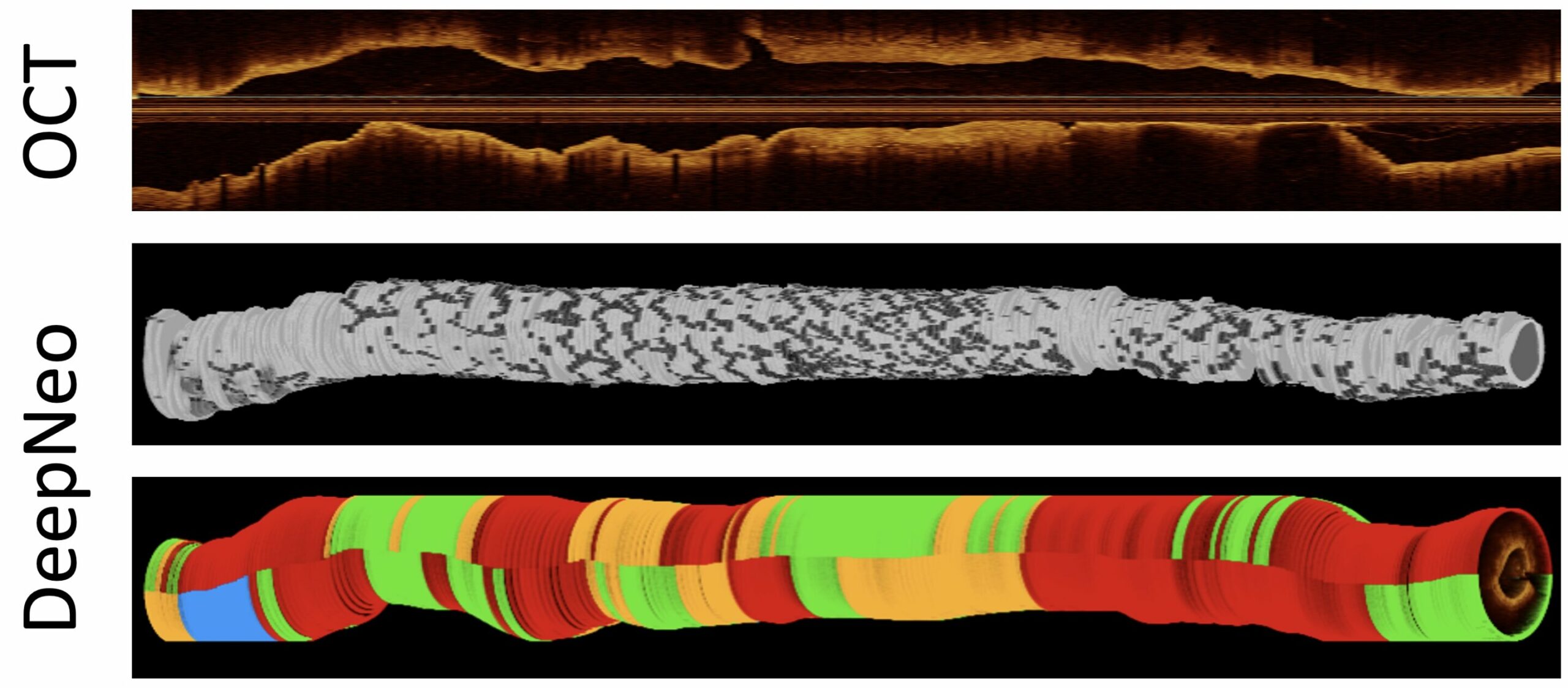 Analysis with the evaluation of stent cure transmission lines in cardiac patients